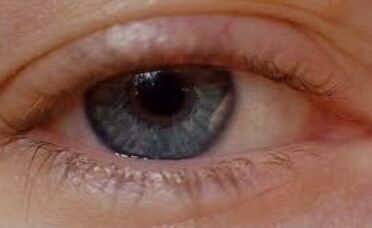 Oculax cured blepharitis