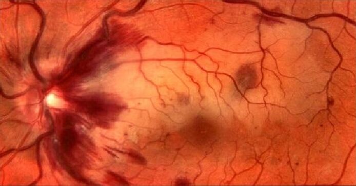 Retina's blood vessel and vision restoration